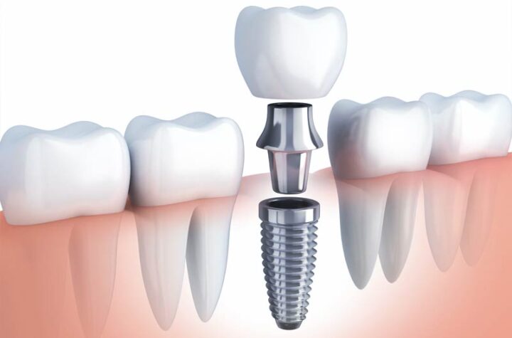 implant dentist Calabasas CA