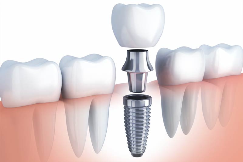 implant dentist Calabasas CA