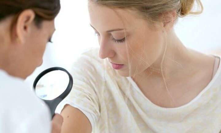 mole treatment Costa Mesa CA
