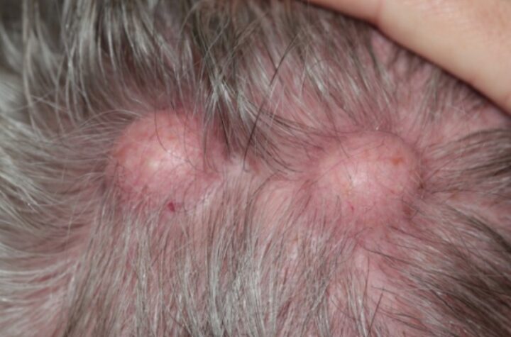 melanoma treatment Irvine CA