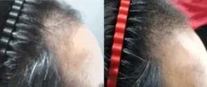 New Jersey hair loss treatment center